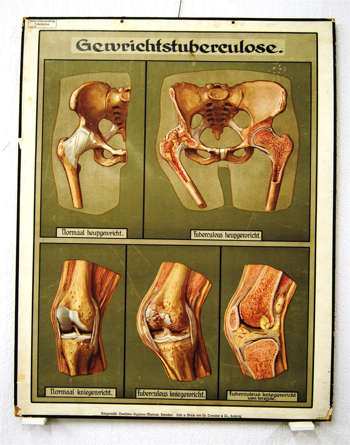 wall chart - Schoolplaat - School Poster - School chart - Teaching chart - poster - schoolkaart - ( SCHOOLPLAAT ) Gewrichtstuberculose